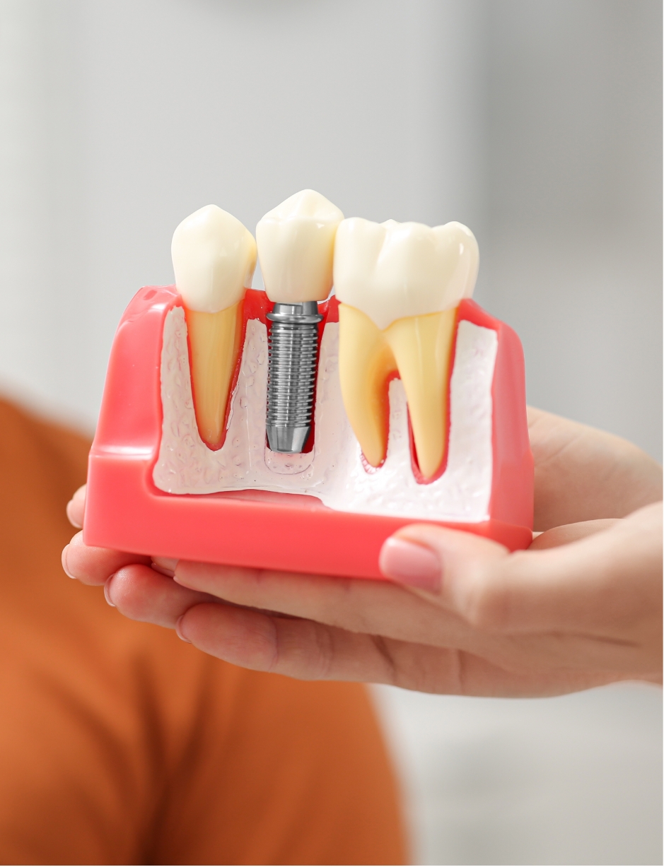 an image showing the process of installing dental implants at the Alain Cyr Dental Clinic