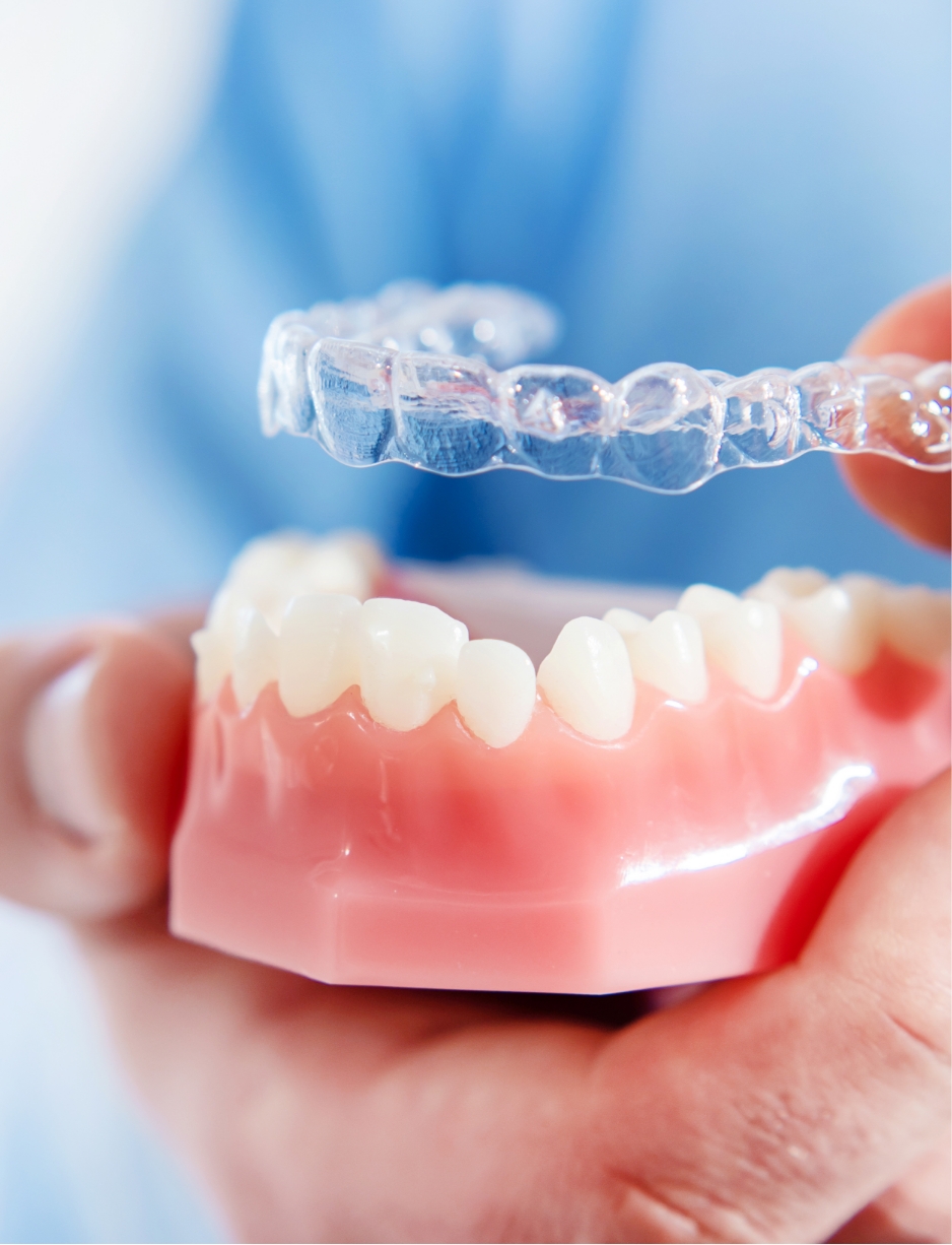 an image showing an example of clear aligners, similar to Invisalign.