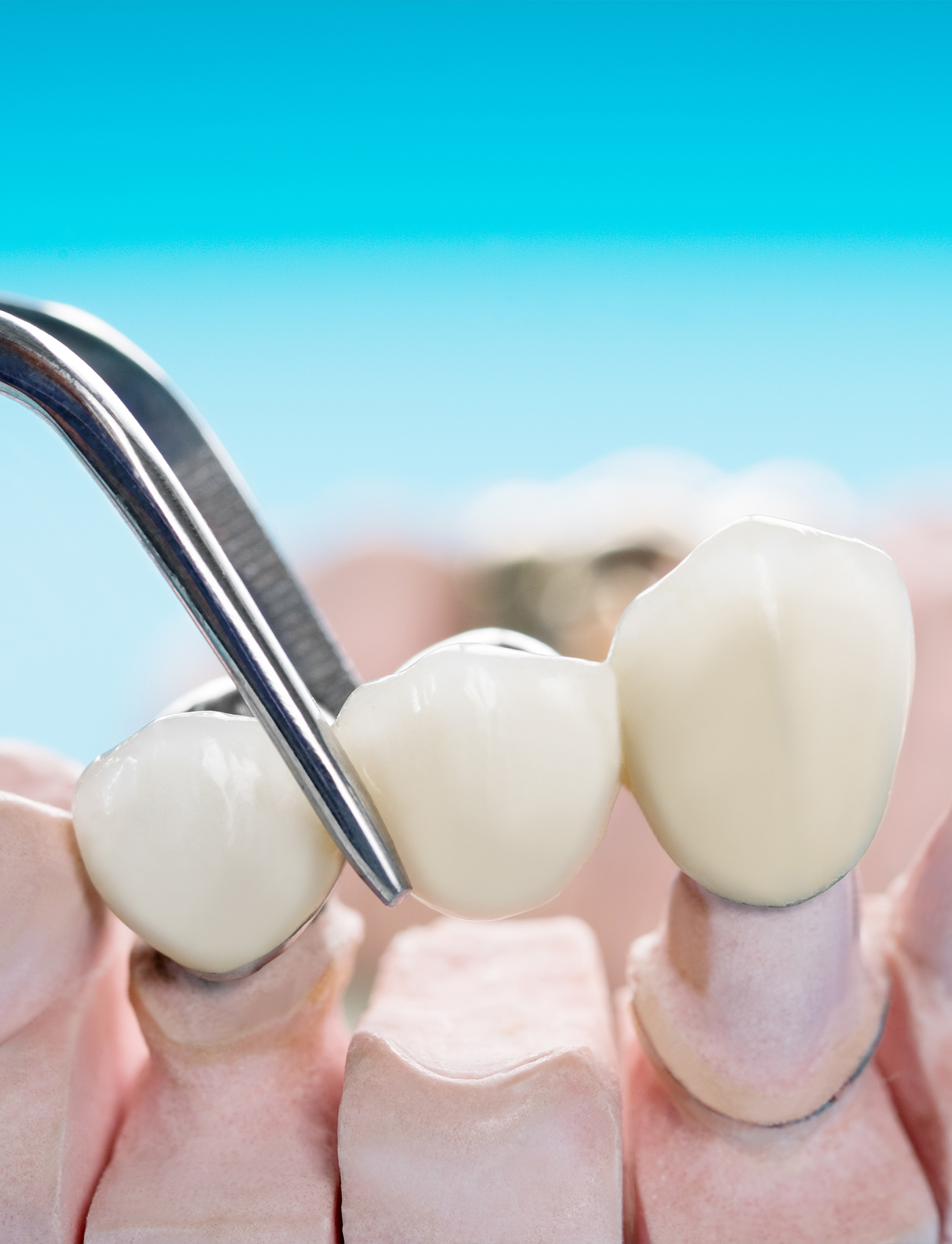 An image of dental bridges, a service offered at the Alain Cyr Dental Clinic in Boucherville